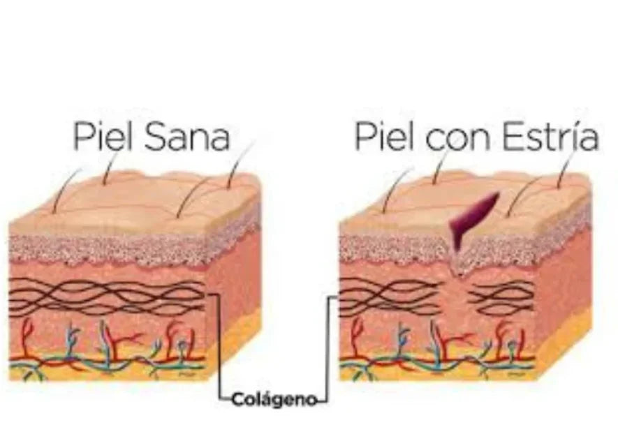 Crema antiestrias con colageno
