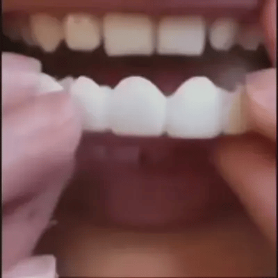 Carillas Dentales SnapOn Smile - Sonrisa perfecta desde el primer uso
